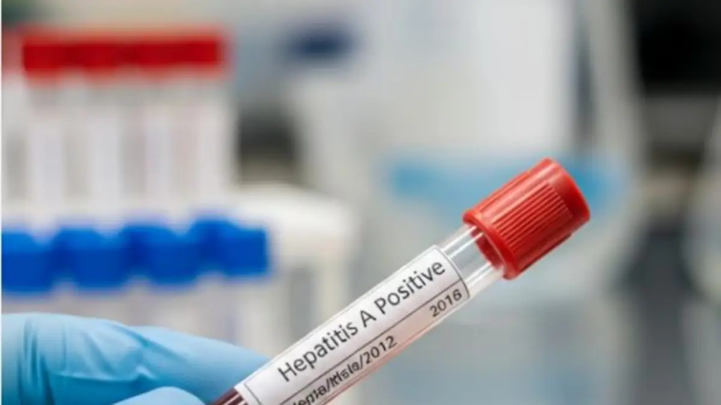 Alerta sanitaria: Se aceleran los casos de Hepatitis A en el pa&iacute;s y detectan la circulaci&oacute;n de un virus poco conocido